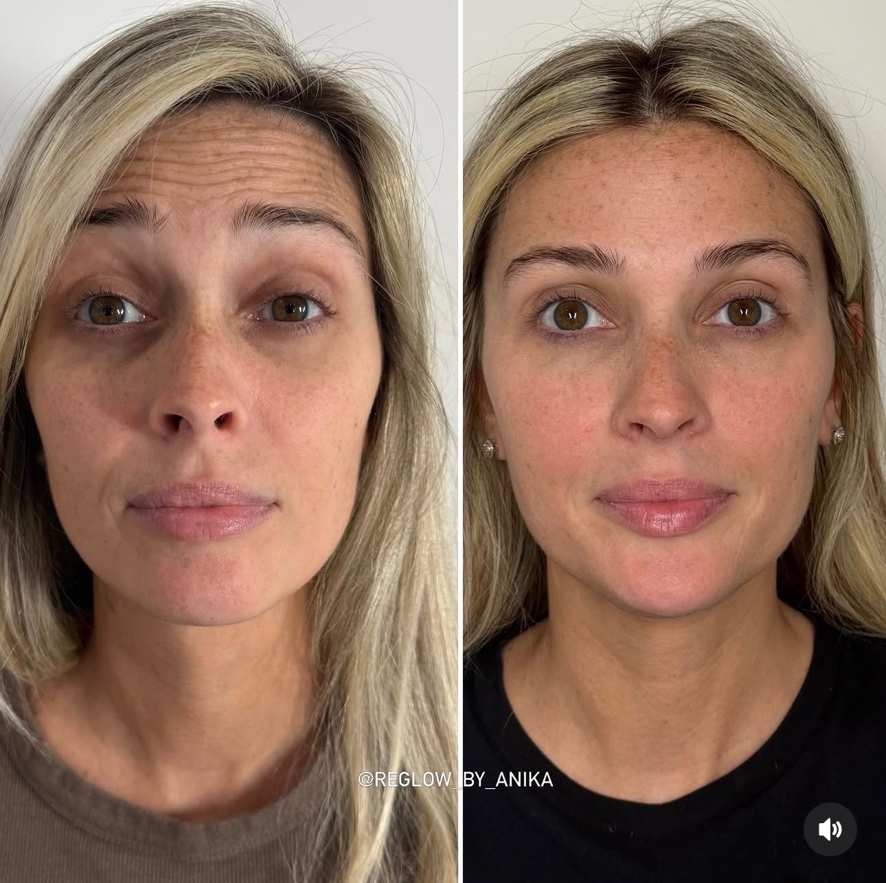 Before and after — Neurotoxins + Dermal Fillers