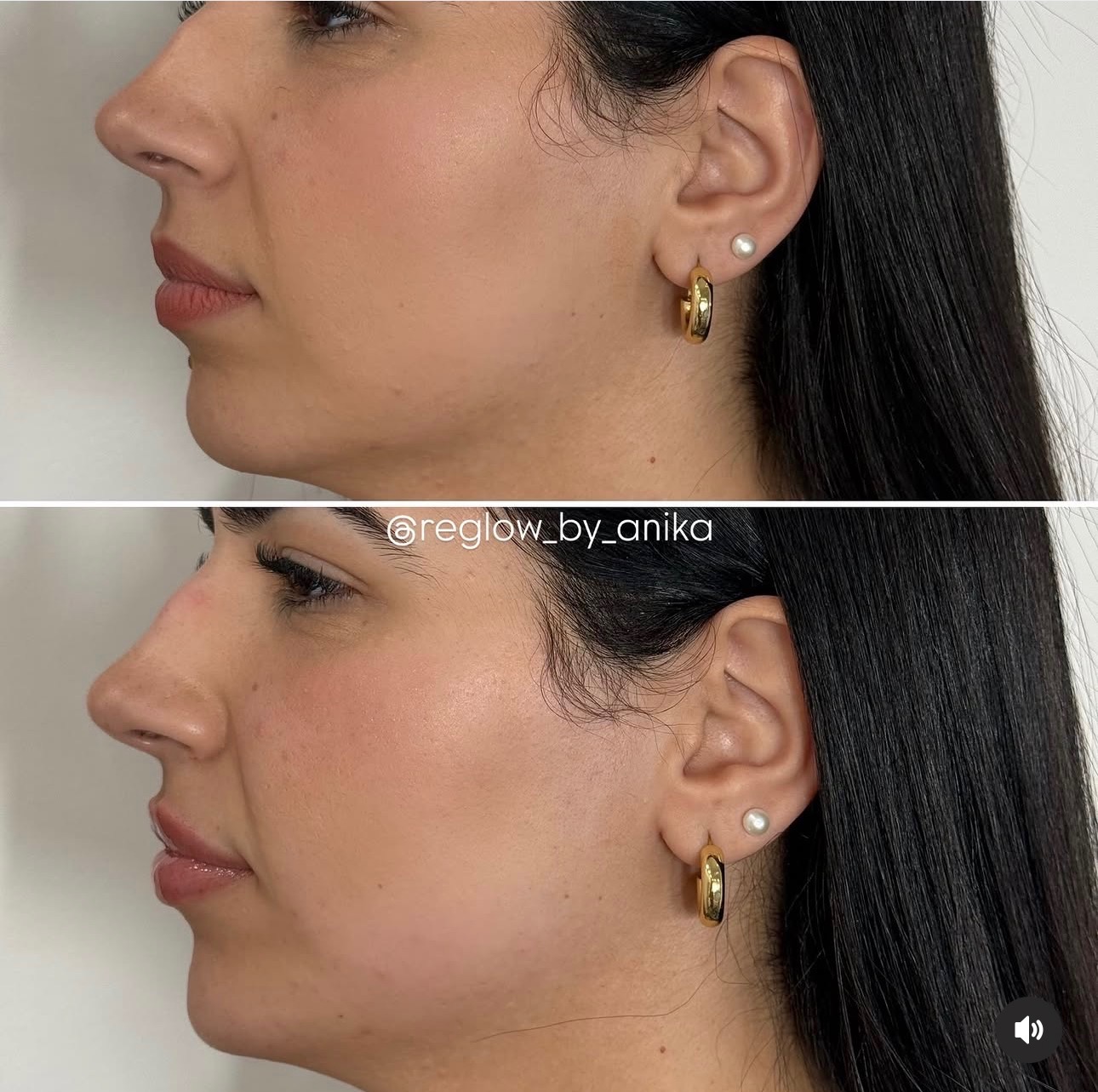 Before and after — Jaw Contouring + Fillers