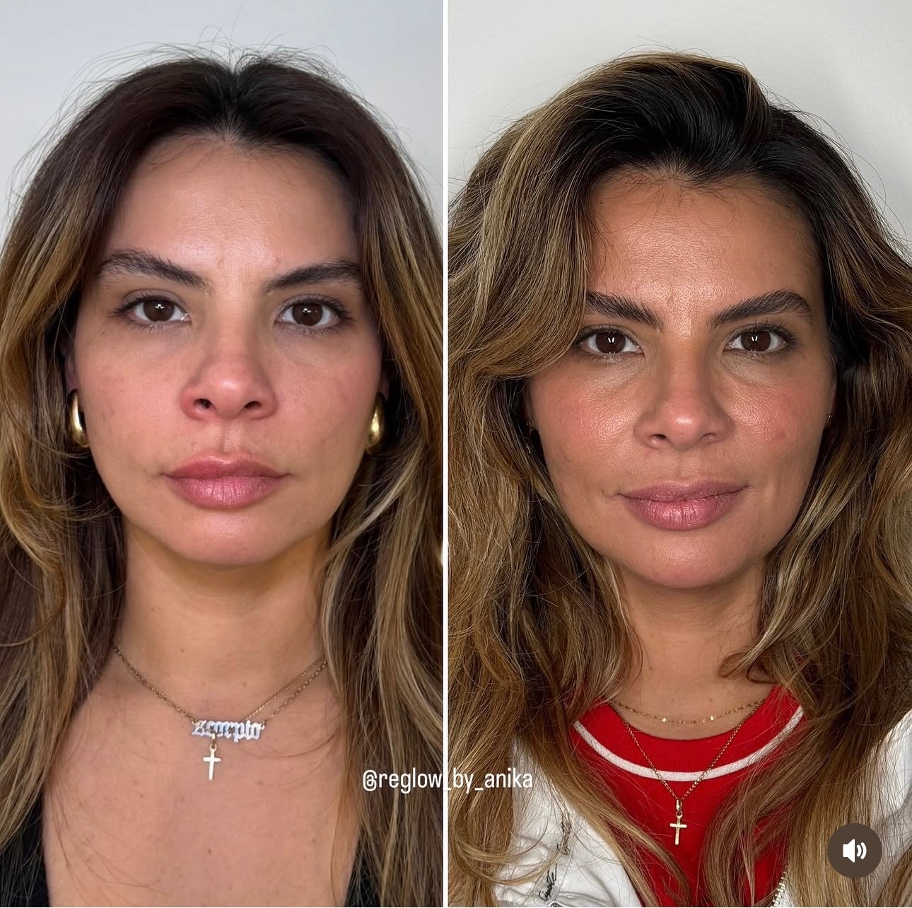Before and after — Sculptra® Biostimulator