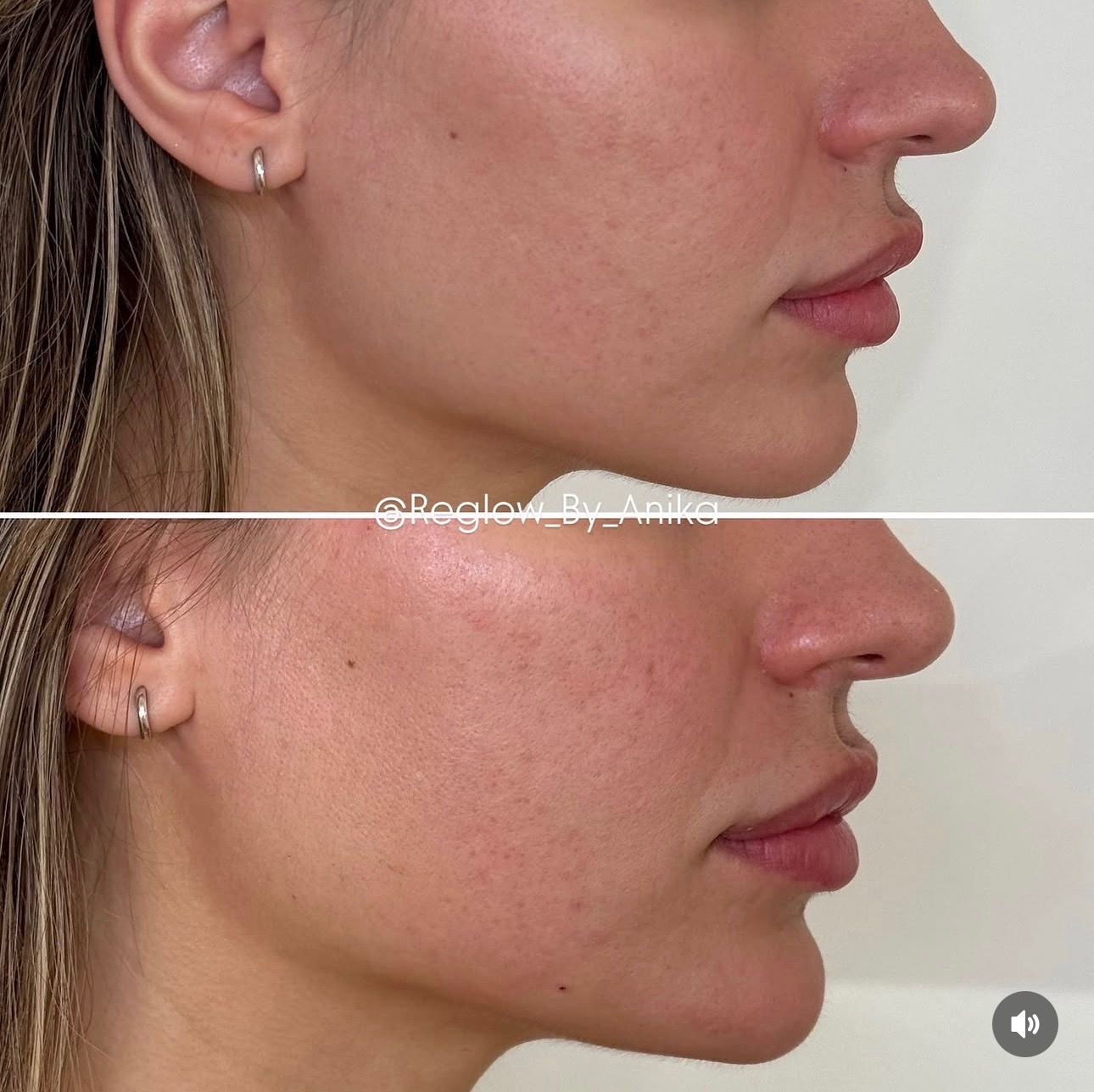 Before and after — Lip & Chin Enhancement
